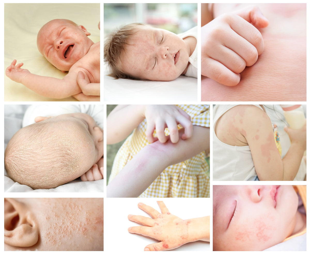 The Best Baby Clothes & Fabrics For Eczema Cuddle Sprouts